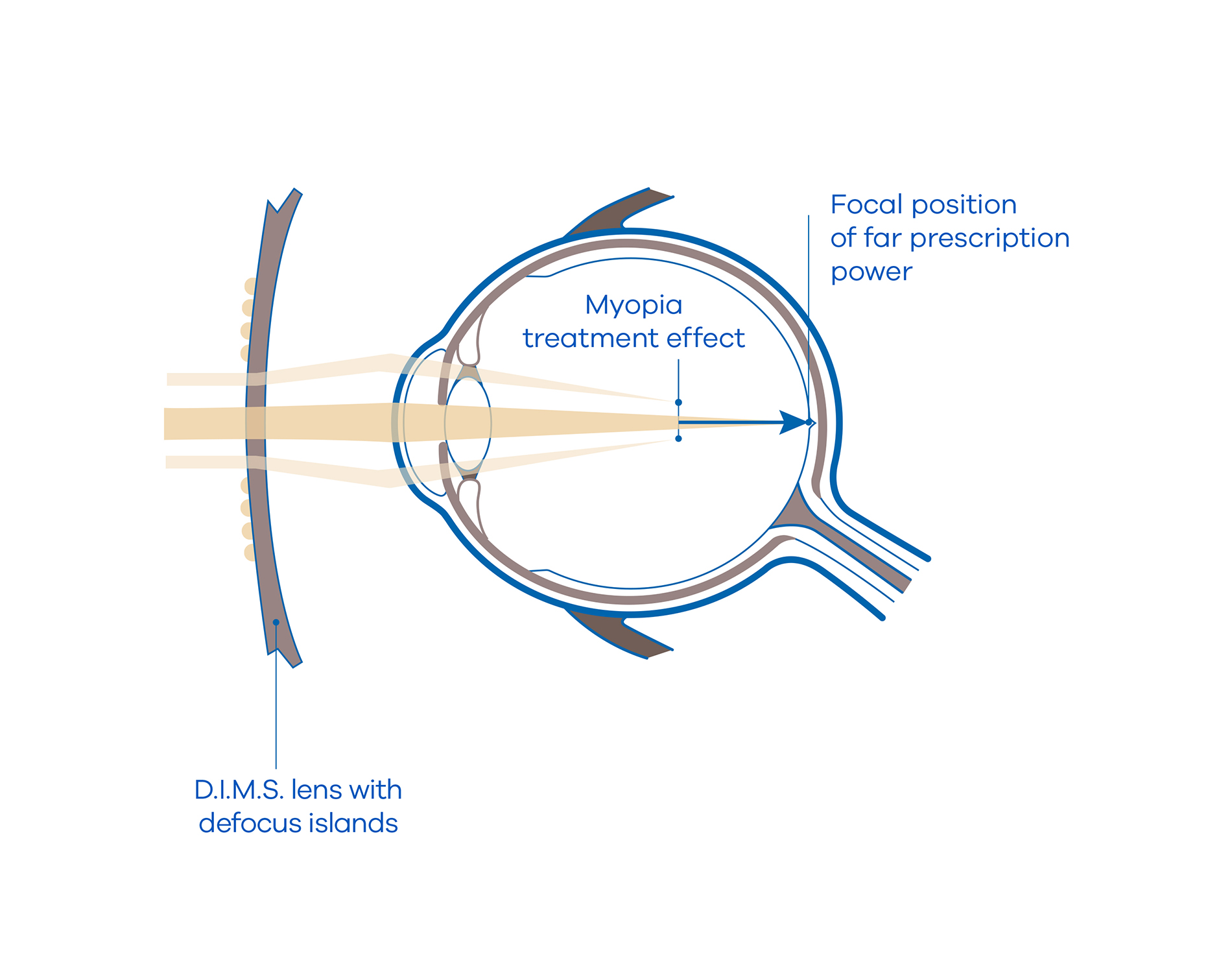 MiYOSMART myopia nearsightedness spectacle lenses HOYA