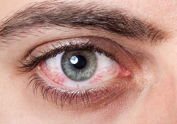 Close up image of conjunctivitis in a male's eye