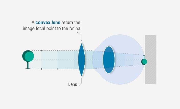 Hoya Vision correct nearsightedness hyperopia diagram