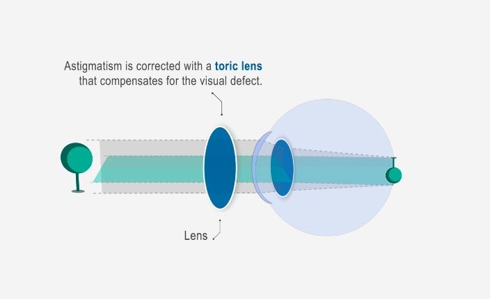 How astigmatism can be corrected