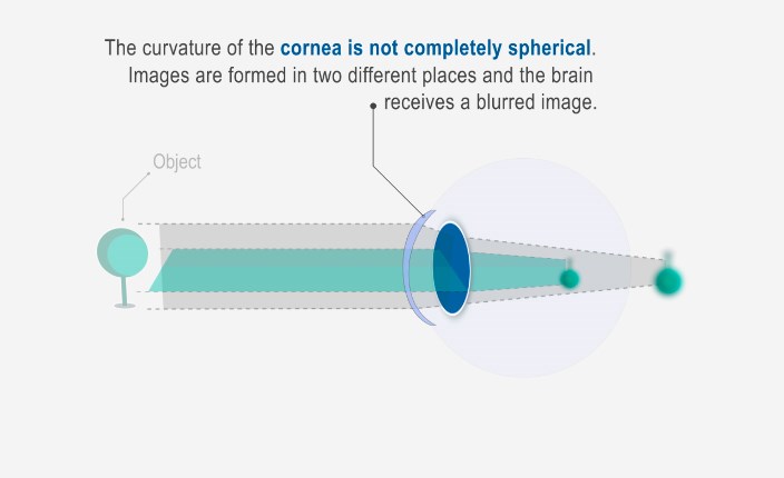 Diagram showing what causes astigmatism