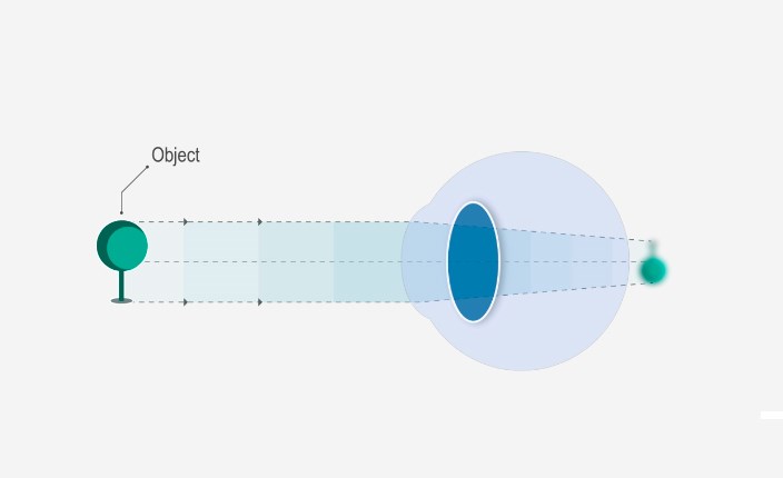 Diagram showing what causes nearsightedness hyperopia