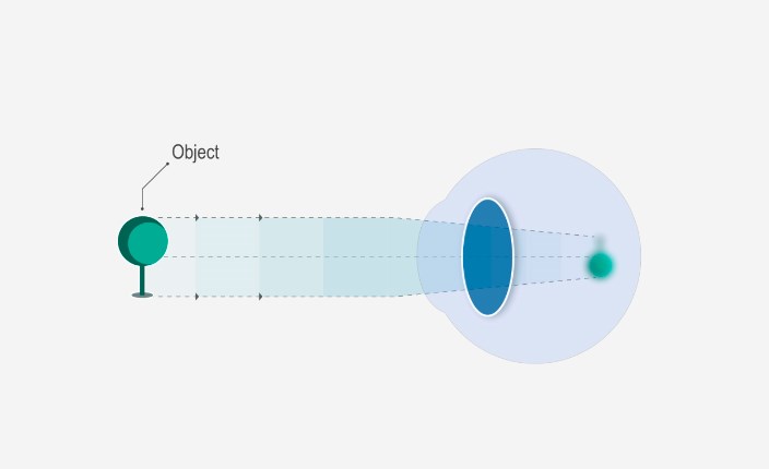 Diagram showing what causes nearsightedness myopia